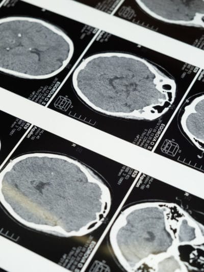 CBD and Concussions brain MRI